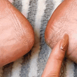 Removedor Pro para Pies Suaves